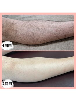 マンケイブ(MAN CAVE)/施術事例