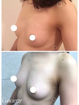 美人バスト 札幌店/バストアップ×育乳 &nbsp;◇症例◇