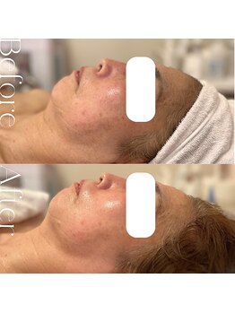 エムベル(M.belle)/リフトアップマッサージ施術前後