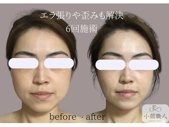 小顔職人/ 小顔ビフォーアフター/30代