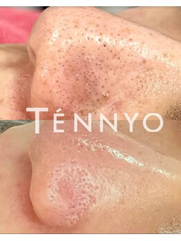 リュミエール デスポワール(Lumiere d'espoir)/毛穴洗浄