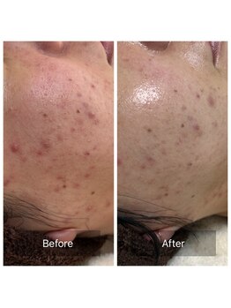 ビジュープラス 筑西下館店(Bijou+)/【30代お悩み】ニキビ/2回目/1M