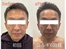 ビーキュート 姫路店(BE-CUTE)/小顔コルギ6回目