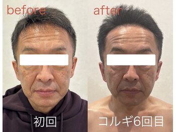 ビーキュート 姫路店(BE-CUTE)/小顔コルギ6回目