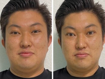 リテルナ(Re.terna)/■小顔頭蓋骨矯正+脂肪分解溶液