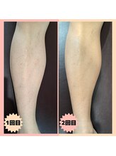 マンケイブ(MAN CAVE)/施術事例