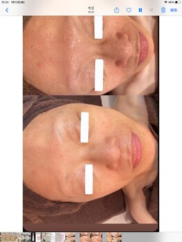 ディオーネ 春日井勝川店(Dione)/マーメイドセルトリートメント