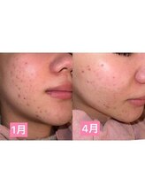 リファラ 光の森店(REFALA)/毛穴・ニキビケア専門REFALA