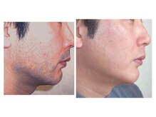 クローバー治療院/ヒゲ脱毛