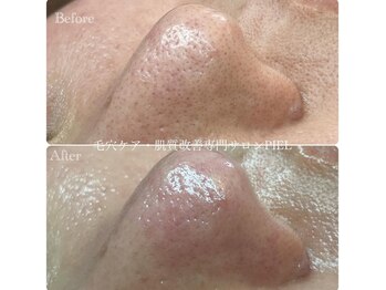 ピエル 北千住店(PIEL)/毛穴だけでなくお肌全体ケア