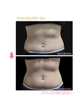 サロン ド 花歩 松山本店/Wキャビ＋レモンボトル施術１回