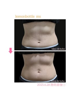 サロン ド 花歩 松山本店/Wキャビ＋レモンボトル施術１回