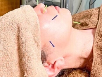 からだちスタジオ 鍼灸整骨院の写真/身体のプロによる本格美容鍼灸！内側から輝く美肌と小顔を同時に叶える贅沢なひとときを♪