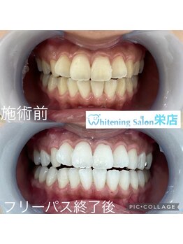 ホワイトニングサロン 名古屋 栄店/【ホワイトニング施術例】