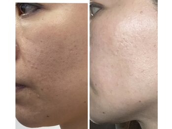 プラチナアース 守谷店(Platinum earth)/ハーブビフォーアフター