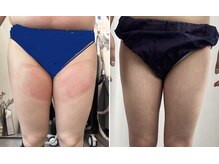 プレズィール(Plaisir)/3ヶ月で太もも→細ももに☆