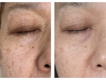 毛穴専科/シミケアで根本改善!沖縄那覇