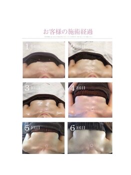 美人バスト 札幌店/バストアップ×育乳 &nbsp;◇症例◇