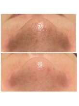 アンヘル(Angel)/毛穴洗浄ビフォーアフター