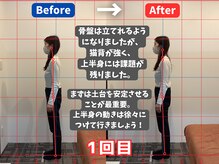薮下整体院 札幌円山店/20代女性　猫背による背中の痛み