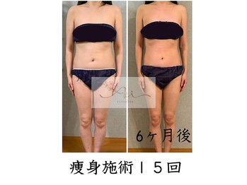アイ エステサロン(Ai)/【40代】痩身ダイエット成功♪