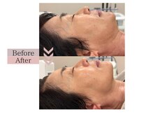 フロリール アザブジュウバン(FlorirAzabujuban)/小顔/リフト/たるみケア