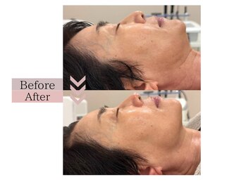 フロリール アザブジュウバン(FlorirAzabujuban)/小顔/リフト/たるみケア