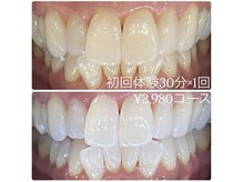 ホワイトニングルーム 横浜店(Whitening Room)/ホワイトニング/横浜