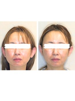 ビーサロン(B-salon)/むくみケア/小顔テラボーラー