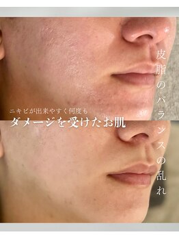 カムイ/肌質改善 ハーブピーリング1回