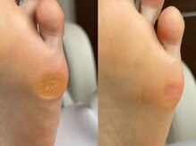 キラネイル アンド アイラッシュ by World Beauty(KIRA)/タコ魚の目除去