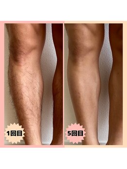 マンケイブ(MAN CAVE)/施術事例