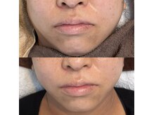 ベルアイラッシュ(Belleyelash)/【フェイシャルワックス】