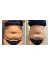 ルナグランデ 心斎橋店(Luna grande.)/下腹ぽっこりも解消