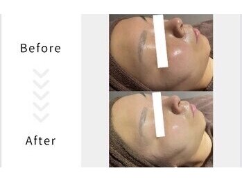 ラヴィオス 渋谷表参道店(RAVIOS)/ハーブピーリング/ララピール