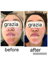 トータルビューティーグラッツィア(Total Beauty Grazia)/肌荒れ以外の肌ももちろん綺麗に