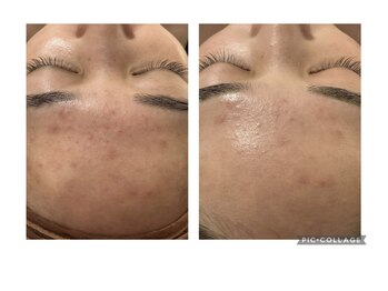 ピリナ(Pilina)/施術