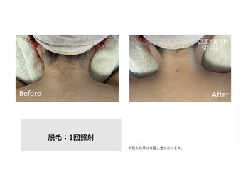 サロン ルアナ(salon luana)/うなじ脱毛 before→after