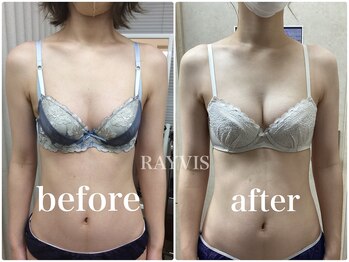 レイビス 郡山店(RAYVIS)/予約殺到★ふわふわ3Dバスト1