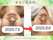 アール シュシュ(R.chouchou)/本気の肌改善ガリレオピーリング