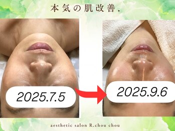 アール シュシュ(R.chouchou)/本気の肌改善ガリレオピーリング