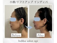 アピ(api)/症例写真【小顔インディバ】