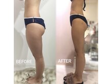 エスグレース 梅田店(S.grace)/ハイパーナイフで美脚！！