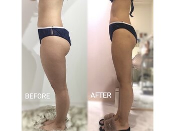 エスグレース 梅田店(S.grace)/ハイパーナイフで美脚！！