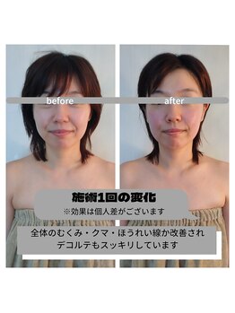 フォーリーフ(4 Leaf)/むくみを解消してスッキリ!