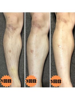 マンケイブ(MAN CAVE)/施術事例