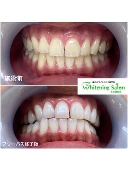 ホワイトニングサロン 名古屋駅店/【ホワイトニング施術例】