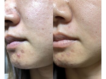 ユウビビューティサロン 東生駒(Yuubi Beauty Salon)/【peel stage】ハーブピーリング