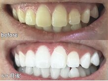 グラーティア 奈良王寺店/ホワイトニング★6ヶ月目★