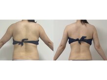 プリマルーチェ/プレミアム背中プログラム